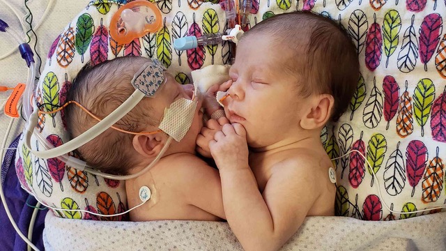 Remi and Reese Erickson Conjoined Twins